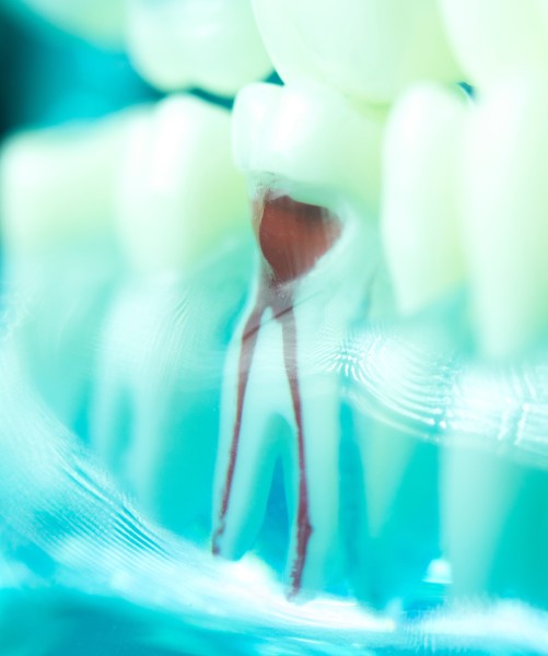 Signs You May Need a Root Canal