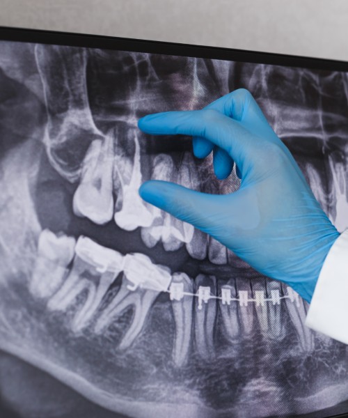 How to Prevent the Need For a Root Canal