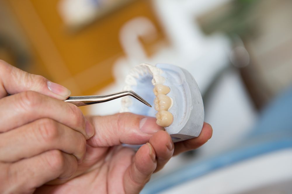 Dental Bridges FAQs